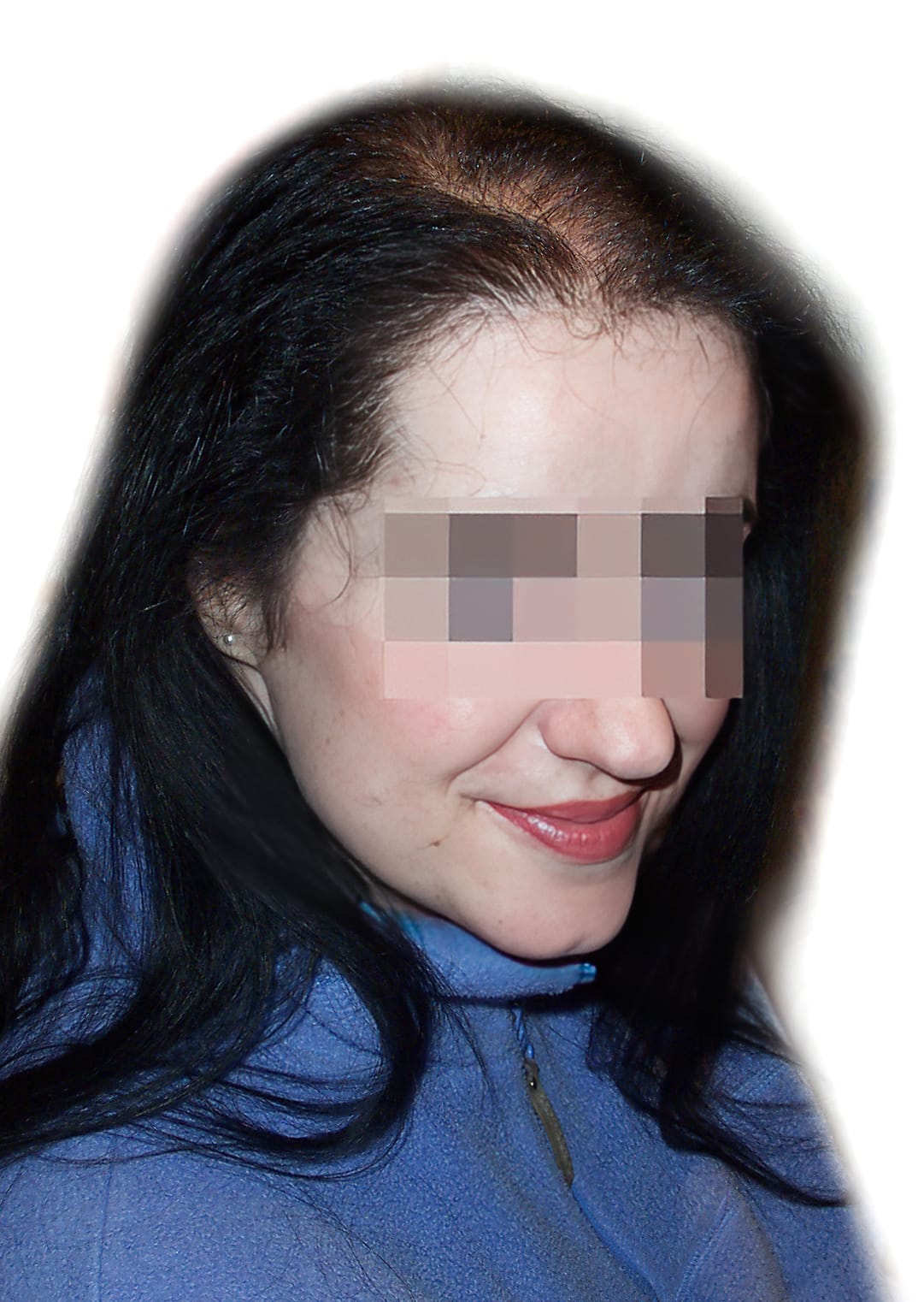 Before Picture - Androgenetic Alopecia